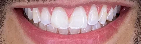 Clareamento-dental-1