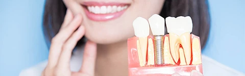 Implantes-Dentarios