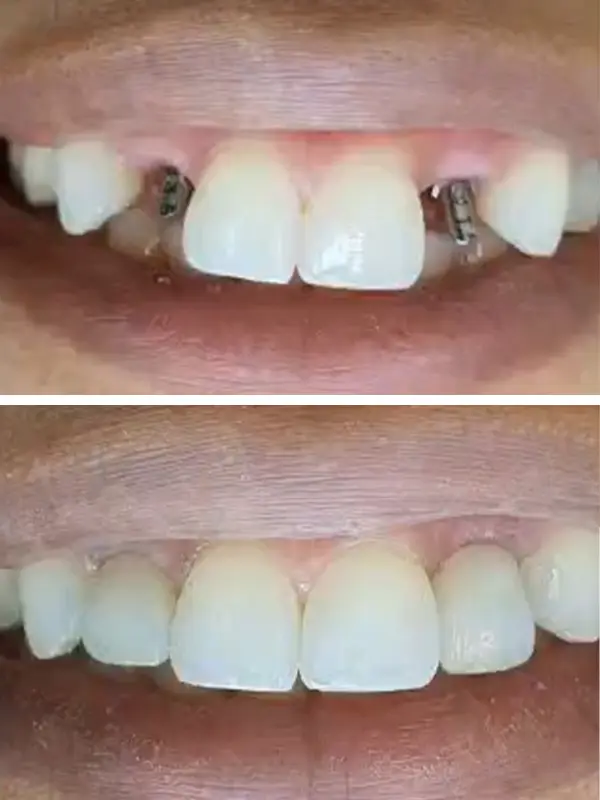 antes e depois (2)