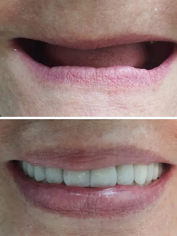 antes e depois (3)