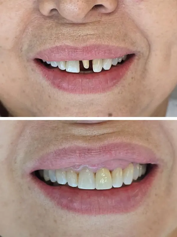 antes e depois (5)