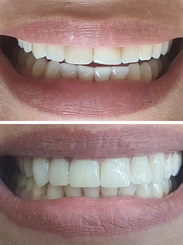 antes e depois (6)