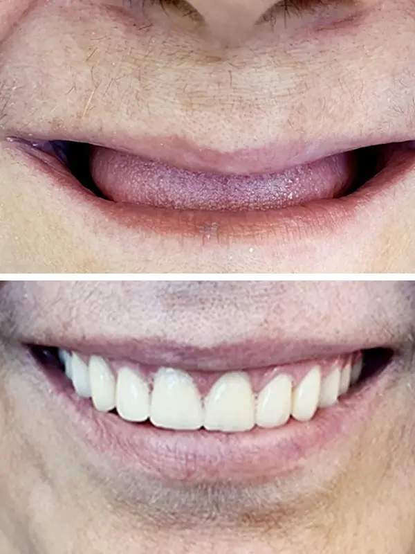 antes e depois (8)
