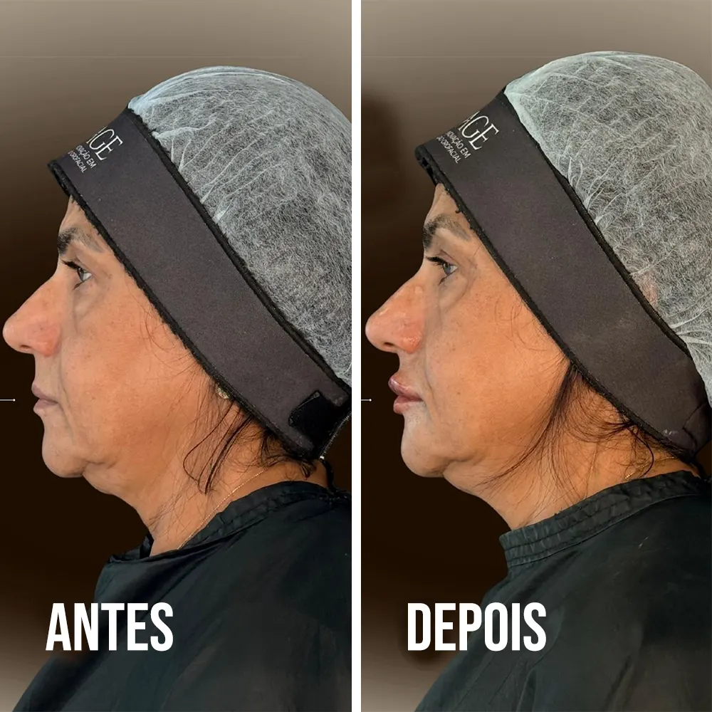 Antes e depois de Harmonização Orofacial